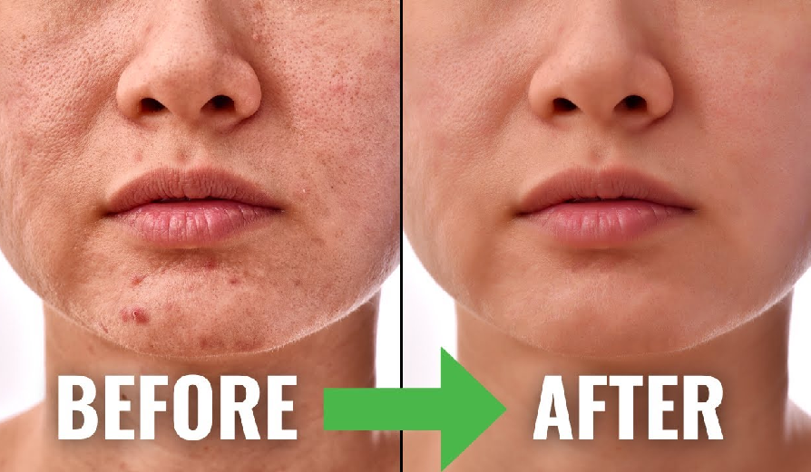antiacne