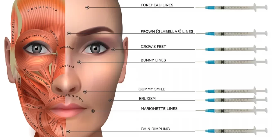Botox e punti di iniezione