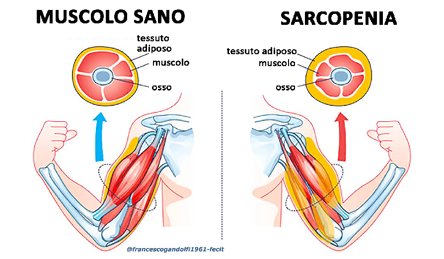 sarcopenia
