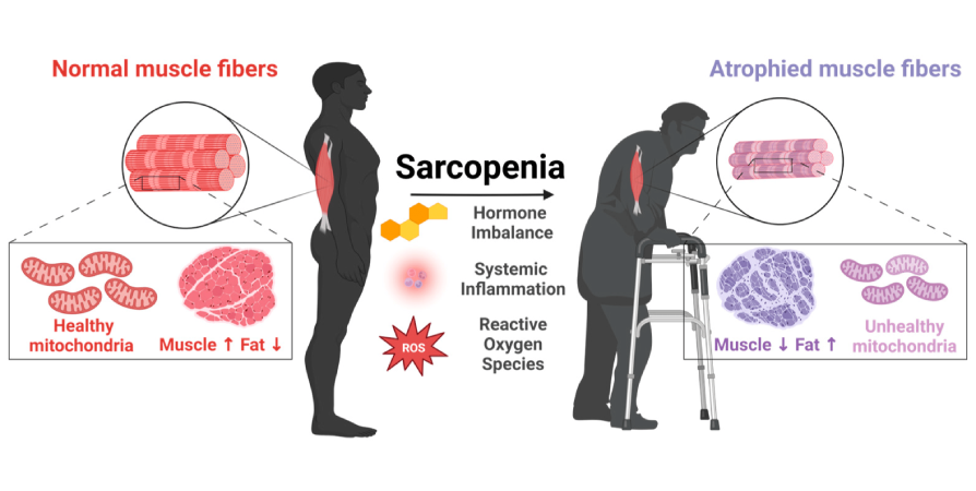 sarcopenia