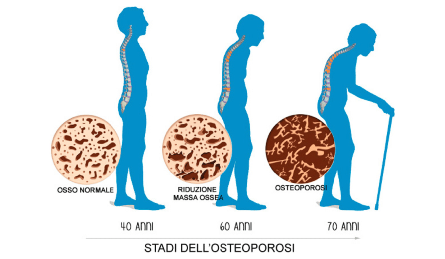 osteoporosi ed età