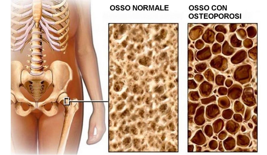 osteoporosi